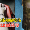 女孩被蛇咬伤奶奶抓蜘蛛吸毒：毒没吸出来，反而加剧毒性