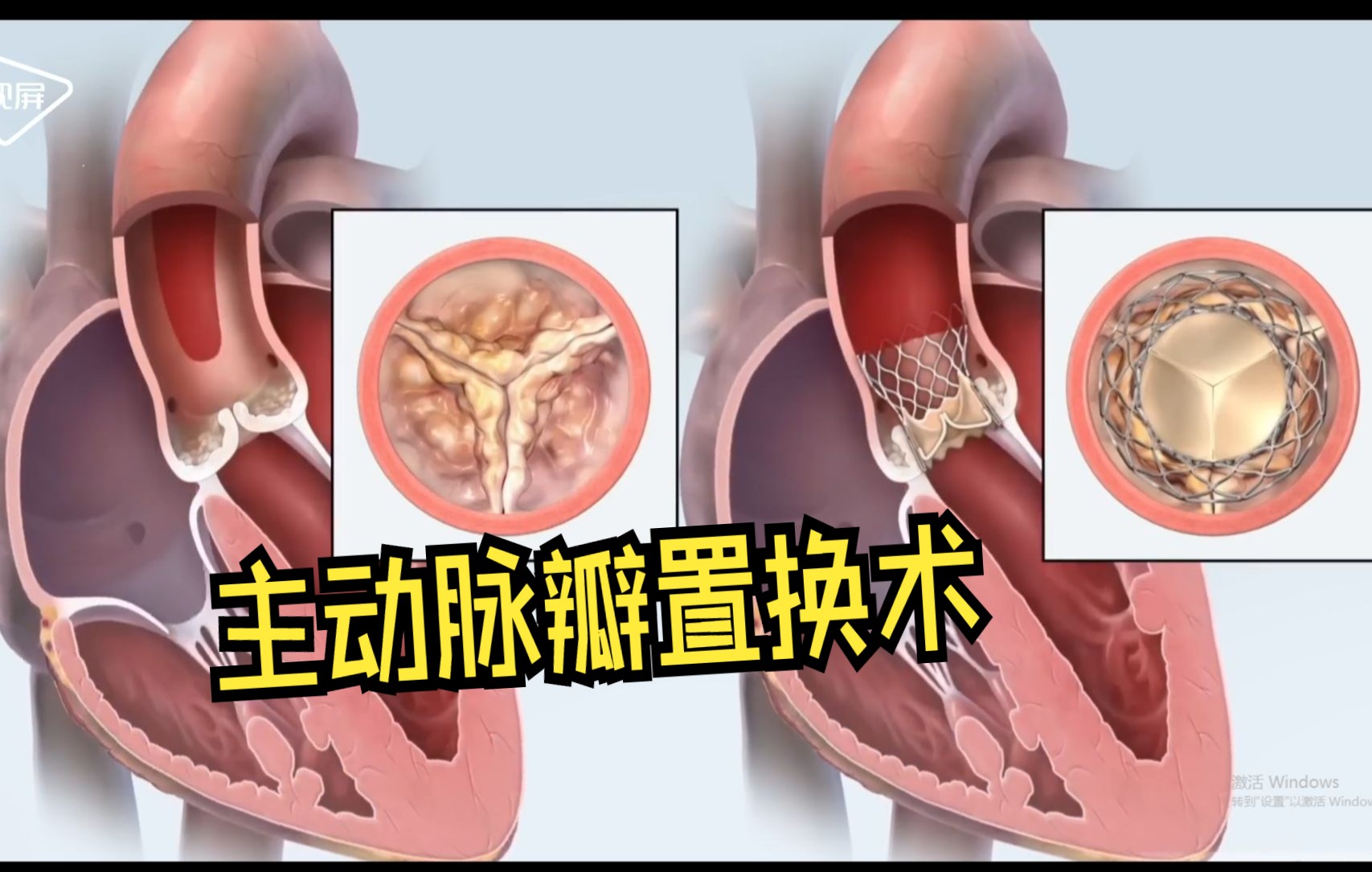 医学3D经导管主动脉瓣置换术 TAVR 主动脉瓣狭窄的治疗方法 哔哩哔哩