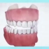 5.多颗牙缺失，怎么种植呢？一起来看看吧