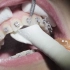 传统牙齿矫正清洁牙齿洗牙过程！