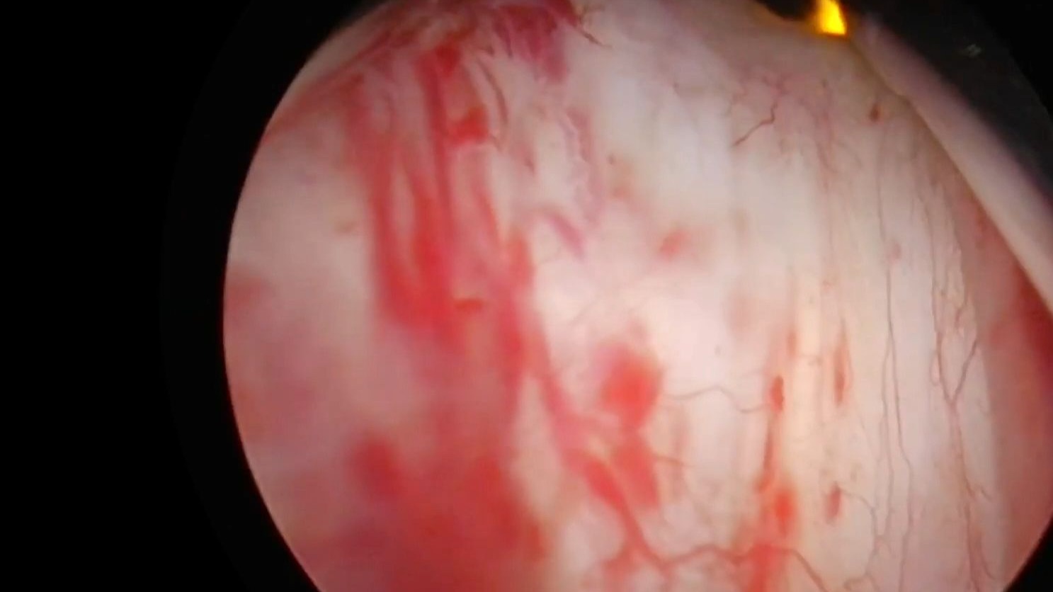 经尿道前列腺切除术