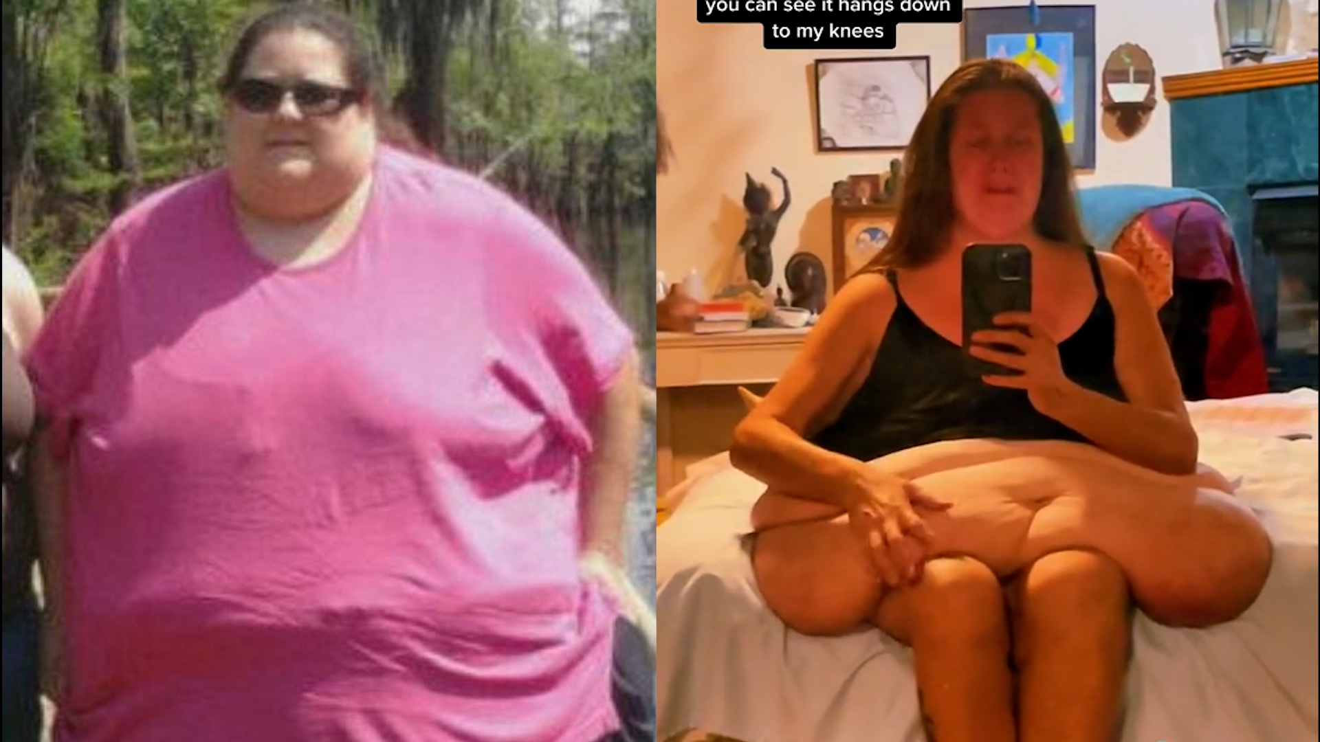 女子4年狂减300多斤，腹部却仍臃肿下垂令她崩溃:将手术再度改变