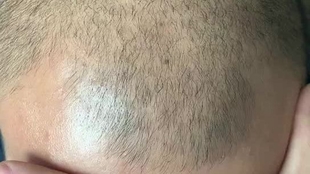 多少岁开始脱发正常 ede5c3c210ee637e4731fcccace3703340e04120.jpg@310w_174h_1c_100q.jpg