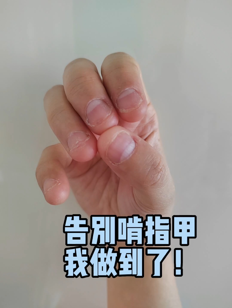 告别啃指甲 我做到了 ！