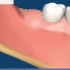 花式拔智齿，你的智齿是哪种？ #牙齿矫正 #智齿