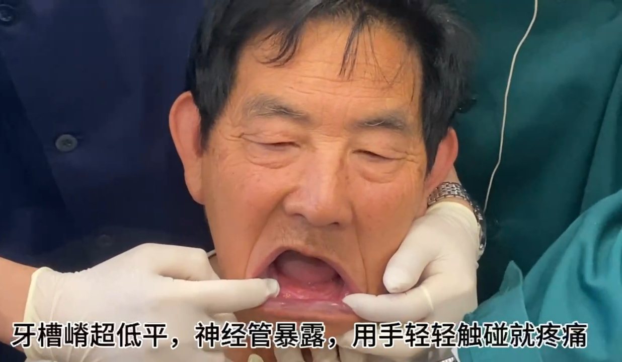 牙槽嵴超低平神经管暴露