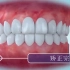 3D动画演示牙齿矫正过程 原理一目了然