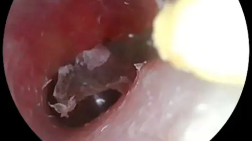 【可视采耳】揭耳皮 有大货