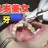 【洗牙】21岁美女去除牙垢牙结石！