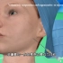 面部自体脂肪填充手术过程，3D演示。。