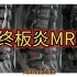 影像报告解读：2型终板炎MRI表现分享，值得收藏！