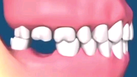 长期缺牙放任不管的后果，看完赶紧镶牙去