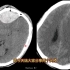 两位外伤患者，头颅CT发现出血，二者之间有何差别？医生分享