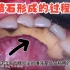 牙齿上的牙结石是怎么来的？揭秘牙结石形成的过程，值得收藏