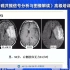 颅内DWI高信号病灶的MRI诊断思路