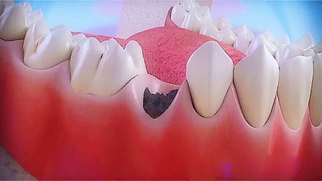 牙齿烂的只剩下牙根了，又不想拔牙怎么办？