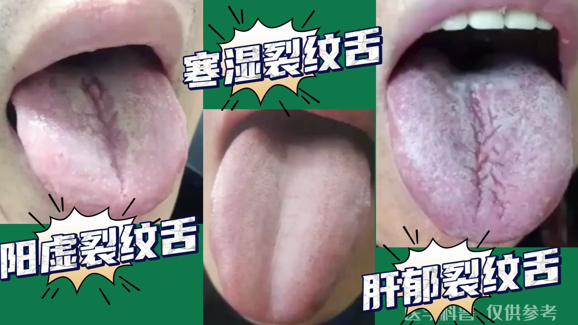 舌象分析：阳虚裂纹舌，  寒湿裂纹舌，肝郁裂纹舌
