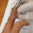 解压系列：断指内的钢丝是如何取出的