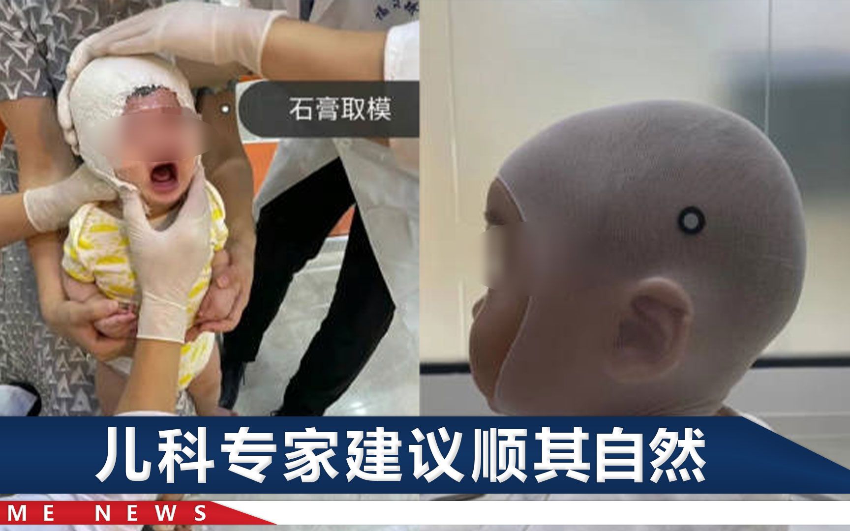 品略/点评:“孩子不能是扁头！”家长给婴儿戴石膏矫正模型，这么容貌焦虑吗[一次目更~]的第1张示图