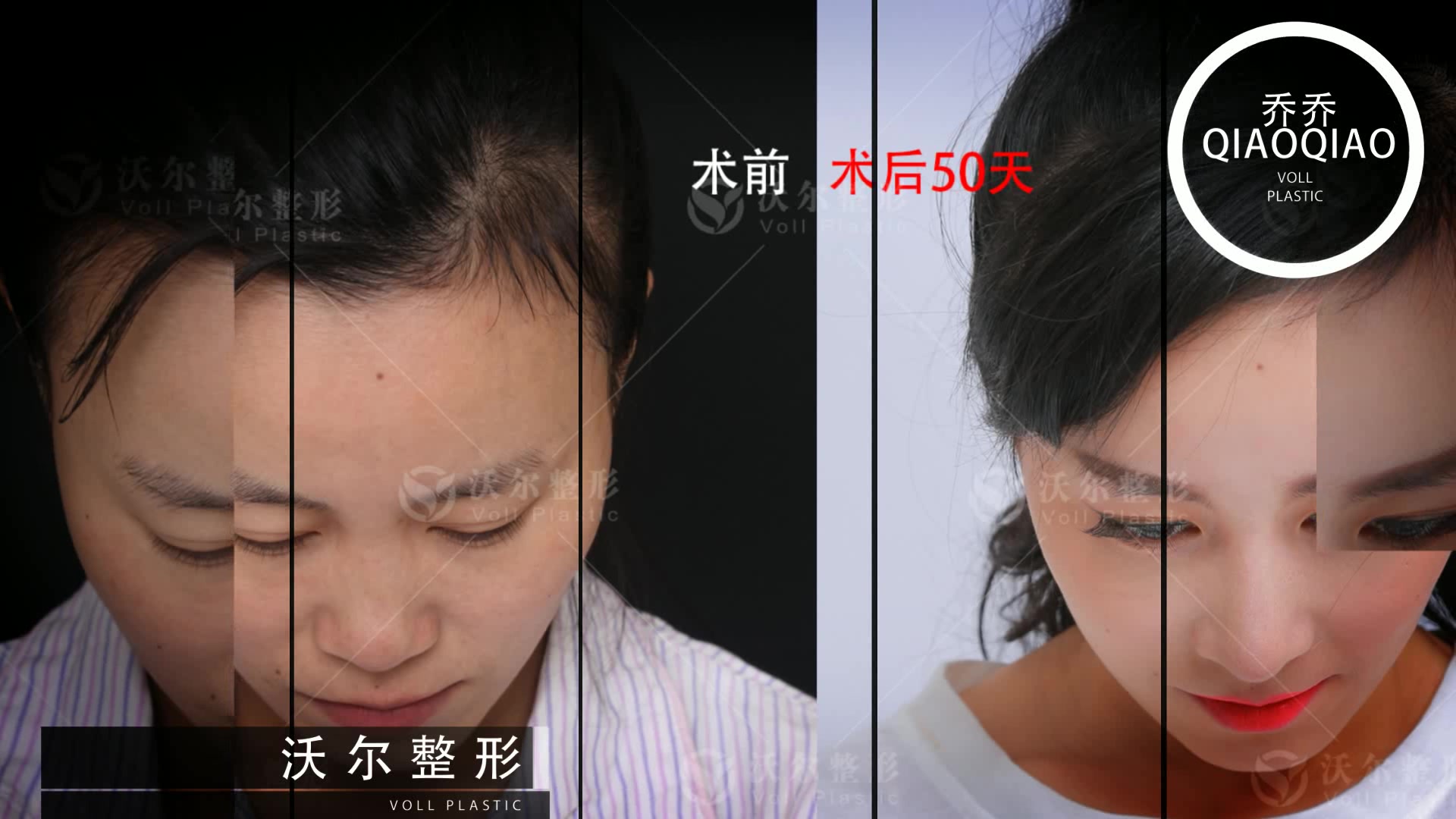031 沃尔乔乔隆鼻前后对比照片-鼻综合是气质的改变