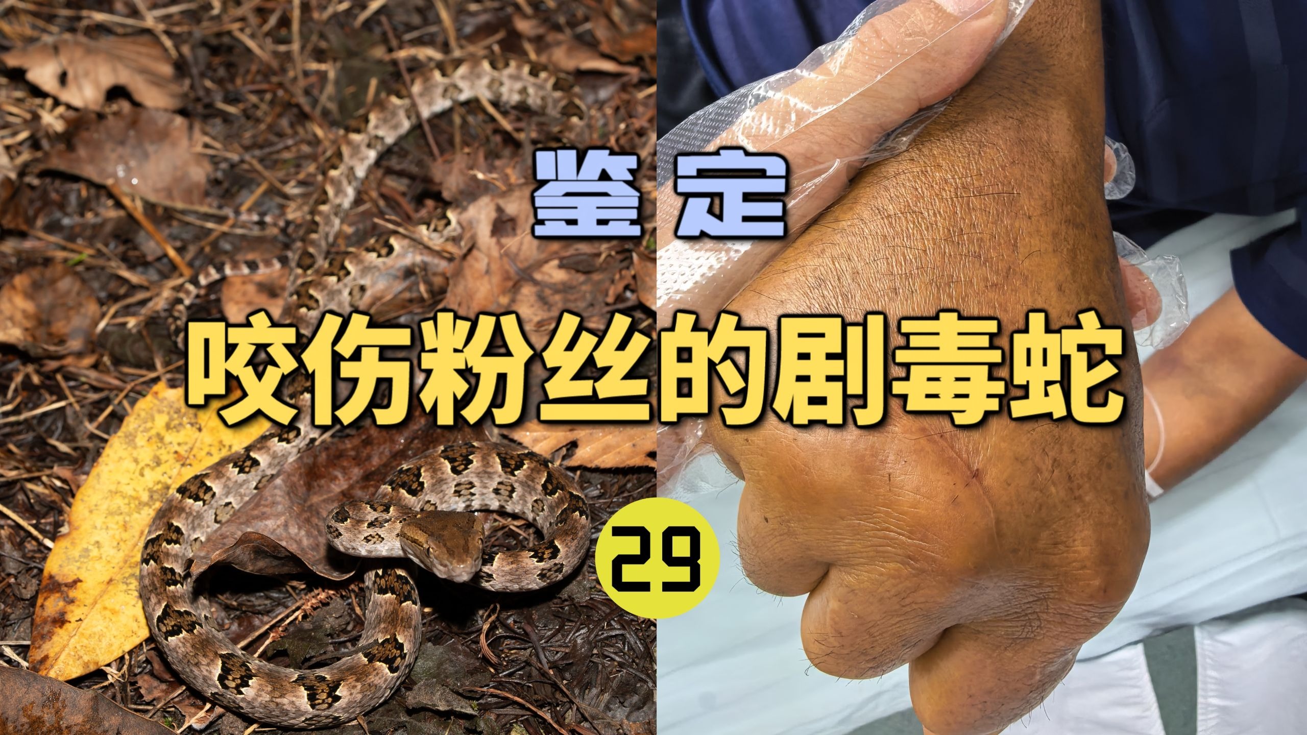 鉴定咬伤粉丝的毒蛇(29)男子疑似被赤链蛇咬伤出现中毒症状？龙雅分析实则为原矛头蝮！-世界记忆大师龙雅-世界记忆大师龙雅-哔哩哔哩视频