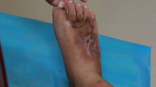 血管炎患者，生活中需要注意这些事