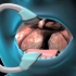 扁桃体切除手术过程，3D演示。。