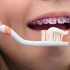 戴牙套怎么清洁牙齿？最权威的教程指导来了