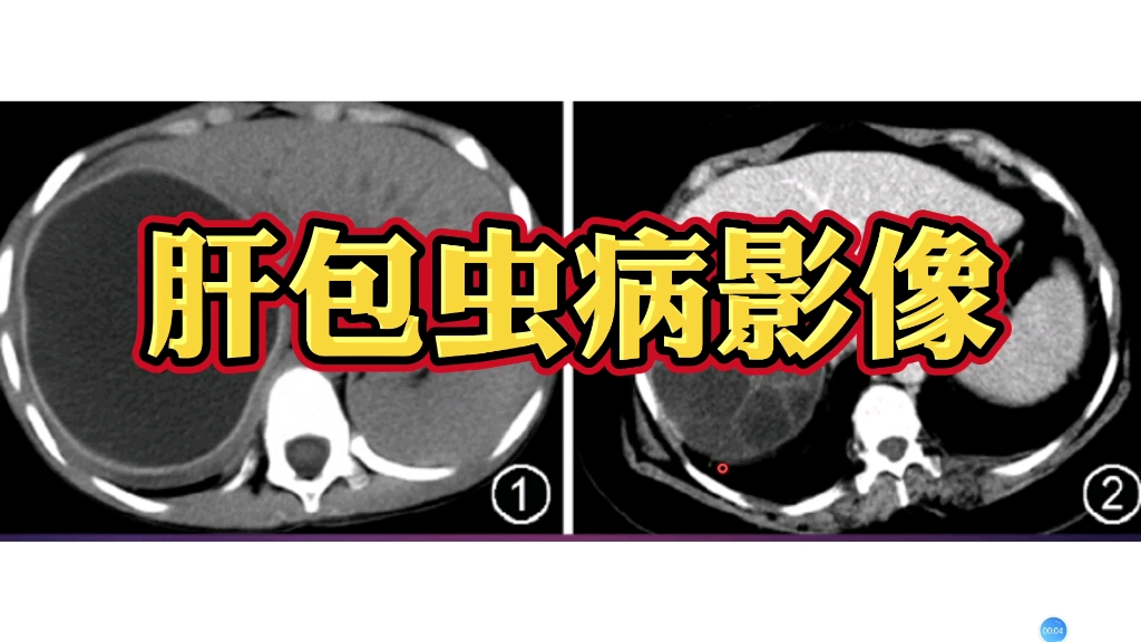 肝包虫病在CT上有哪些表现？放射科医生讲解，简单易懂！