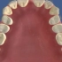 扩大牙弓避免拔牙矫正，你的牙齿可以这样做吗？