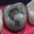 牙齿修复全过程 4K 审美能不能提高一点？
