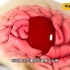 在头上打洞治疗脑出血 硬膜下血肿钻孔引流手术过程，3D演示。。