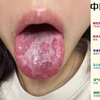 25岁小姑娘手淫九年，舌苔剥落不说，还天天挖喷泉