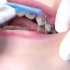 牙齿矫正之橡皮圈的各种挂法