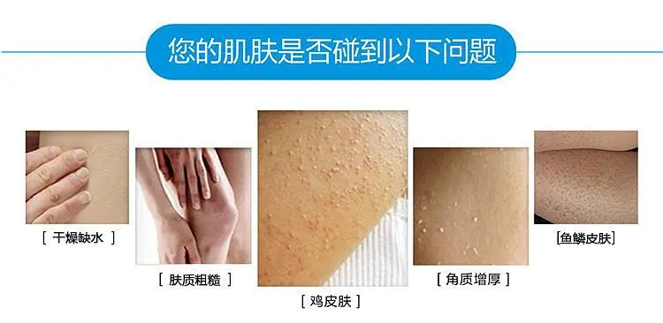 有毛周角化症怎么治 好方法大家都应该知道