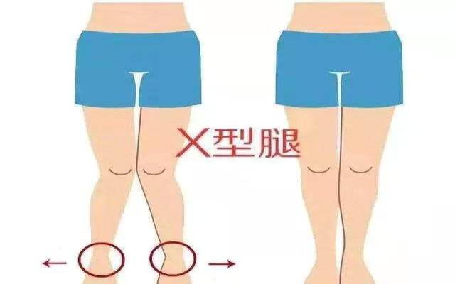 体型体态测评x型腿