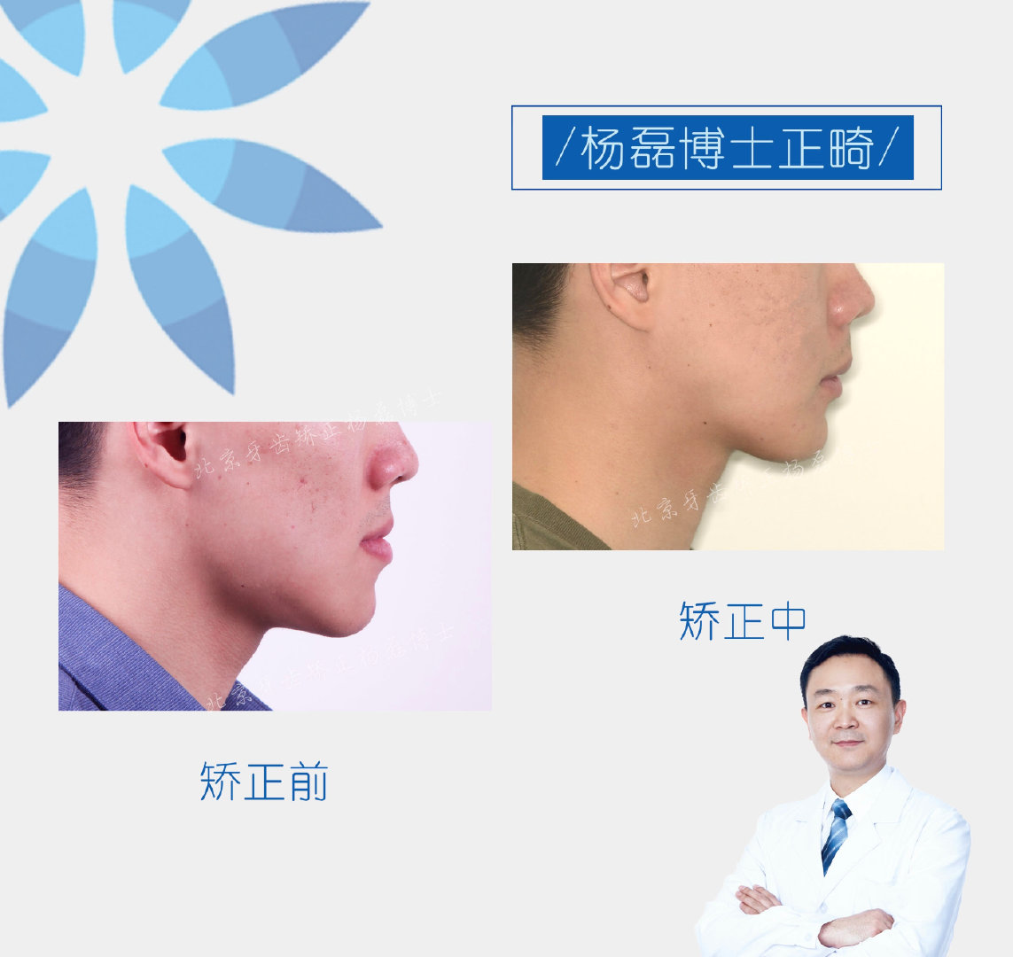 北京牙齿矫正杨磊博士正畸案例:骨性反颌偏颌患者的蜕变之路