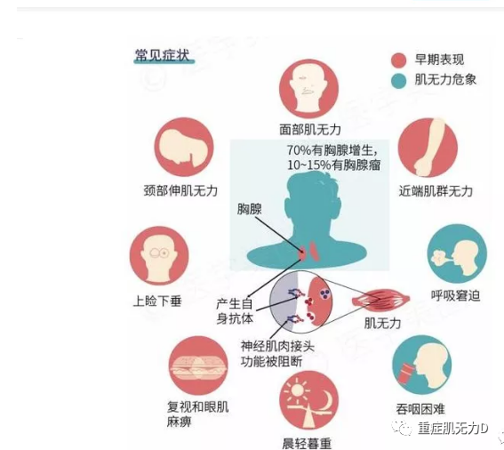 重症肌无力的小百科(一)