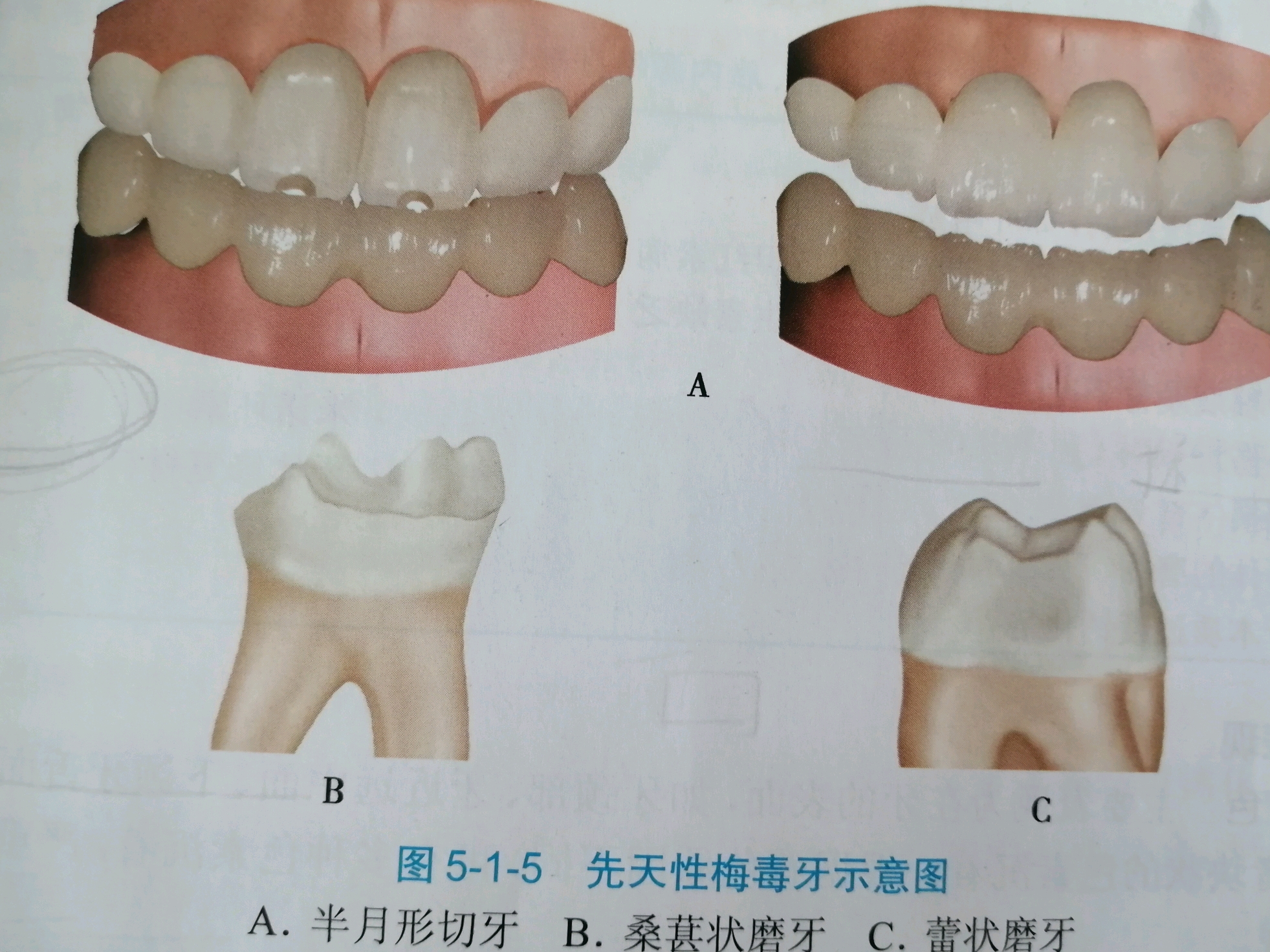 ①半月型切牙(哈钦森牙):切缘比牙颈部窄.