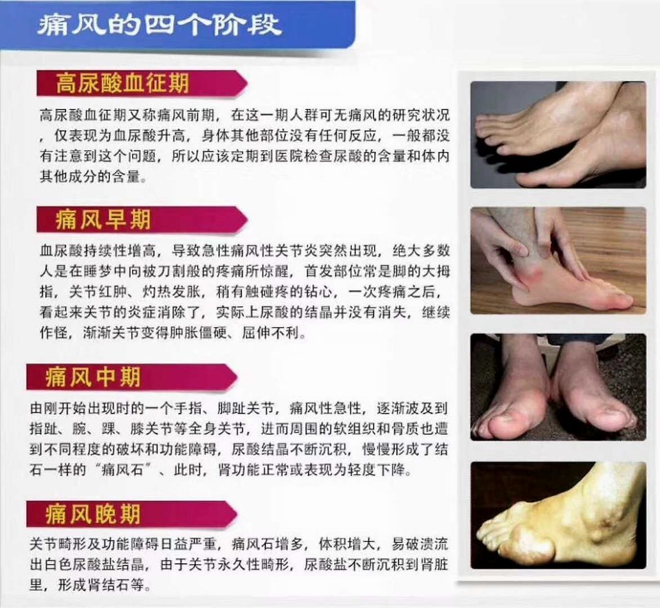 源头降尿酸吴建设关于痛风这四个真相你必须知道