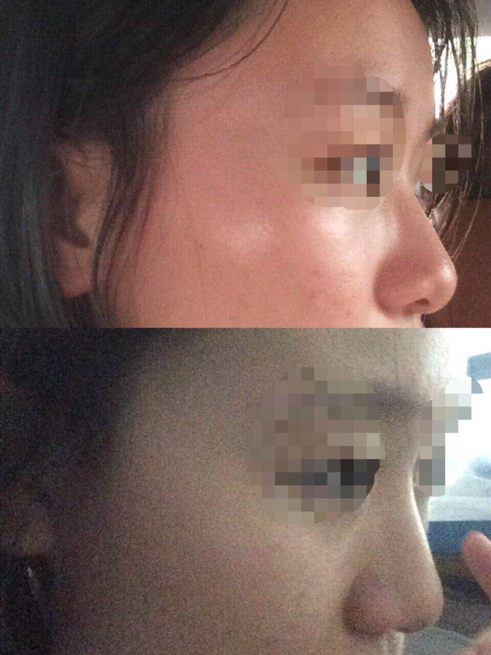 鼻梁变高一些