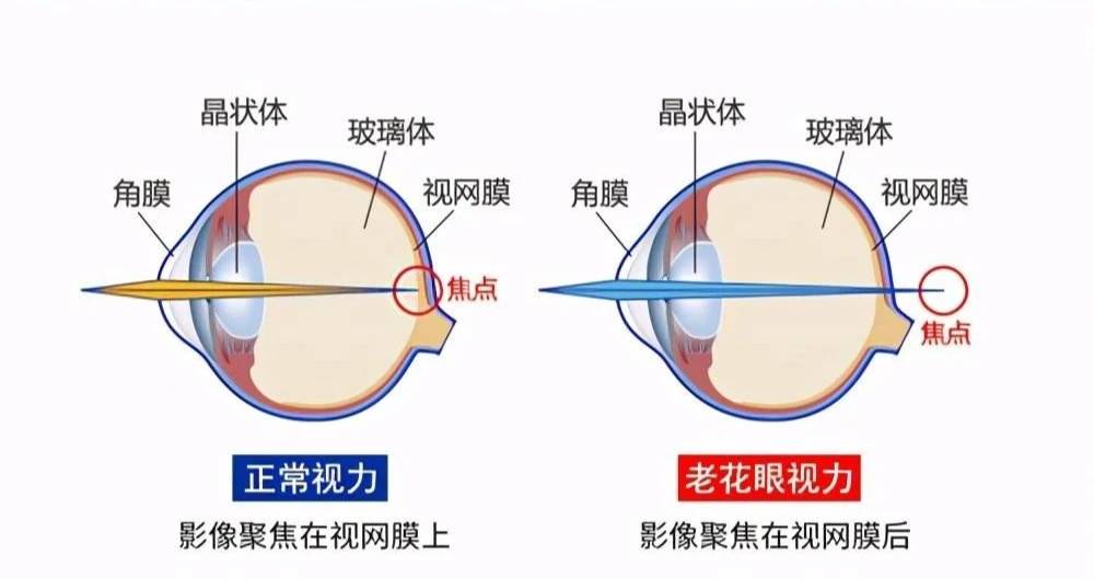 屈光镜是什么,屈光镜是什么意思