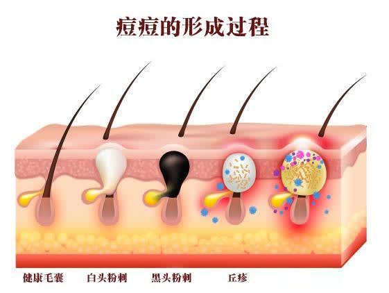 皮脂腺堵塞就长痘痘?那你了解皮脂腺么?