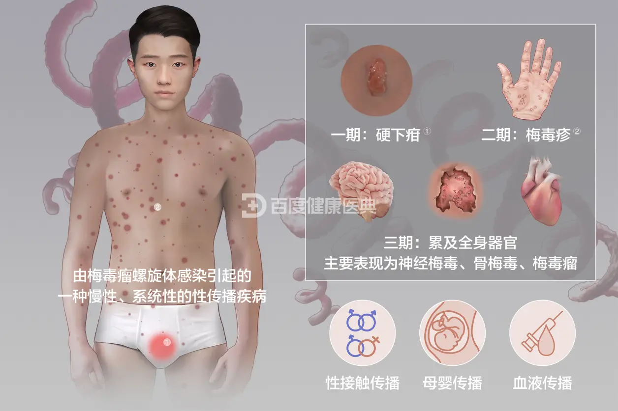 梅毒