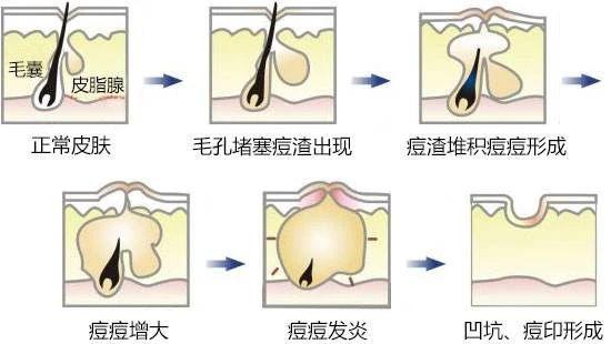 2,环境因素:空气污染,水污染都有可能导致青春痘过后形成痘印.