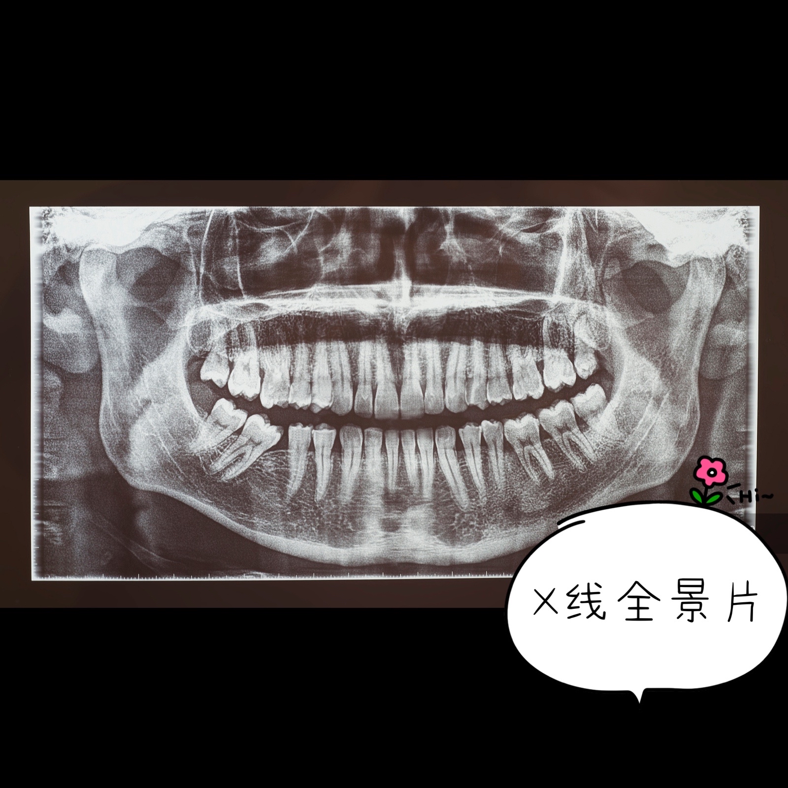 x线全景片是从正面拍一张能看得到你的全部牙齿的牙位,牙列,牙根情况
