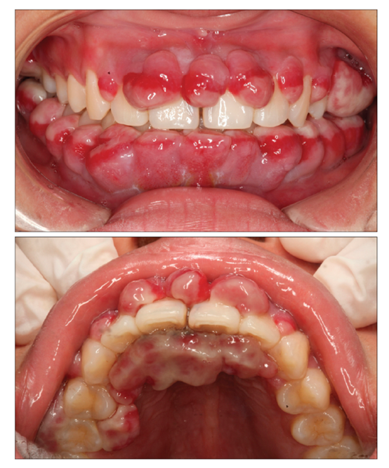 牙龈上长了个瘤子是什么东西严重吗