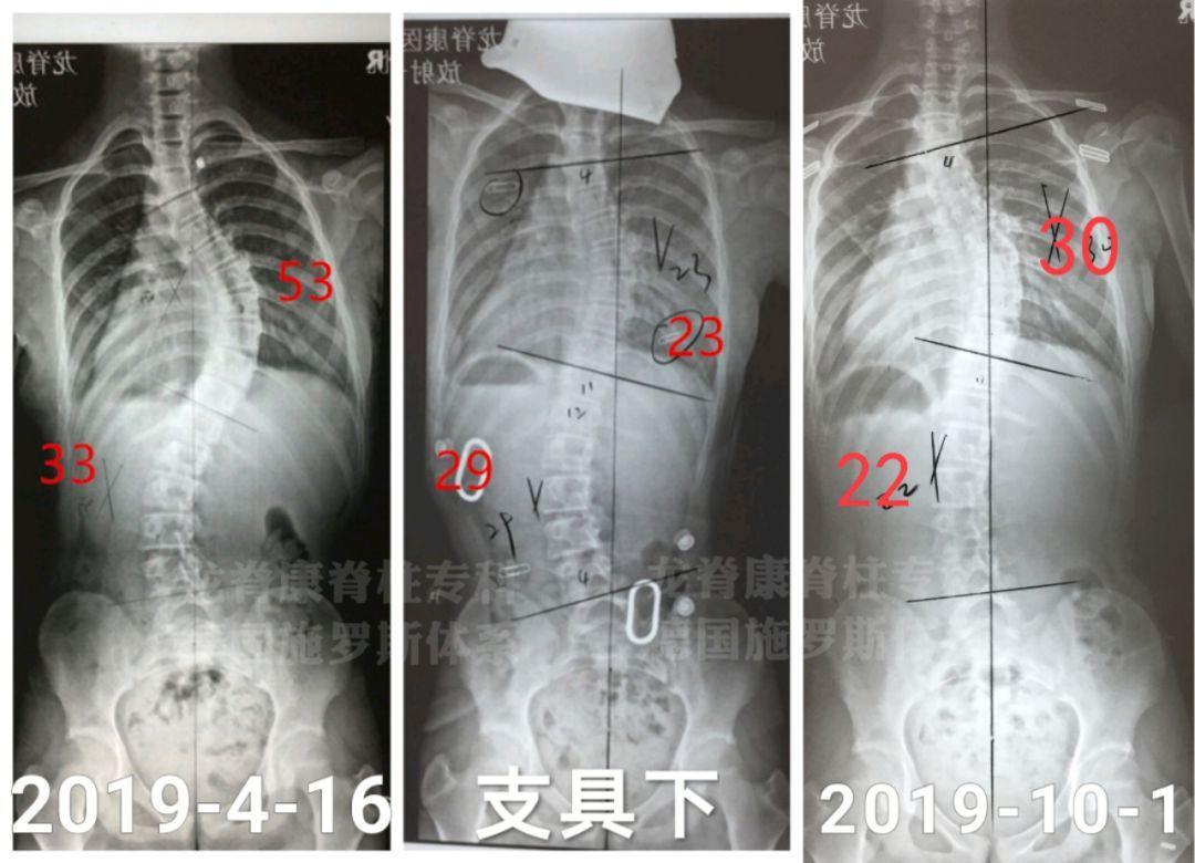 24个脊柱侧弯冷知识你知道几个