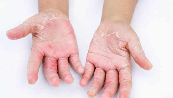 身上瘙痒是怎么回事儿 18c90843ed2ab49d6754cc765cb8b7dfa26059b7.jpg