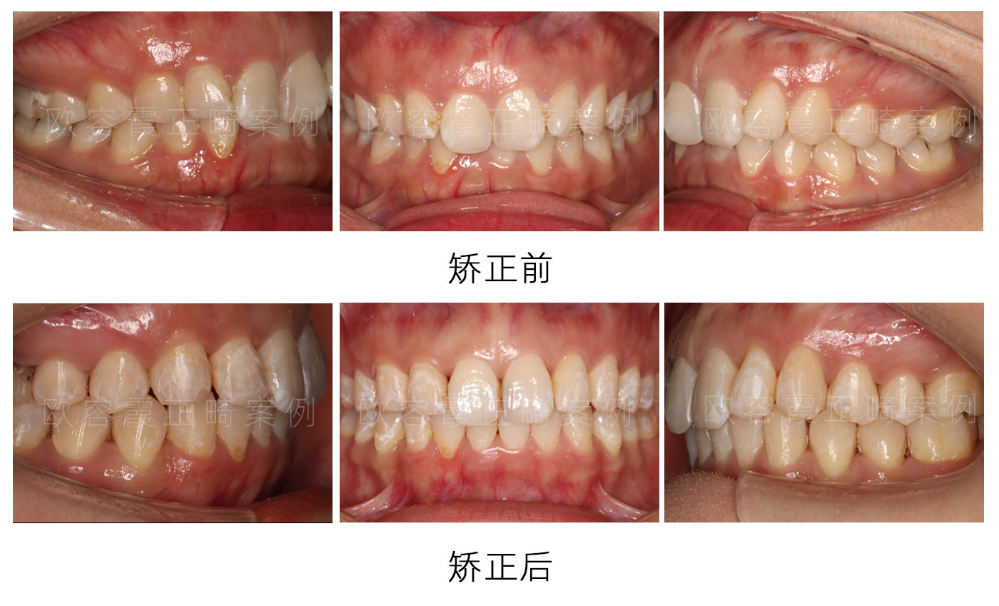 深圳隐适美牙齿矫正欧容霞案例集:深覆合正畸 美学修复联合治疗的正畸